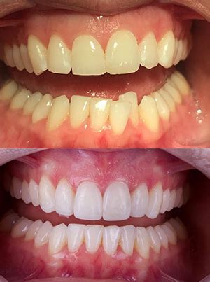 bupa dental invisalign.
